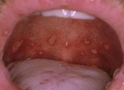 Oral STDs Info Treatment